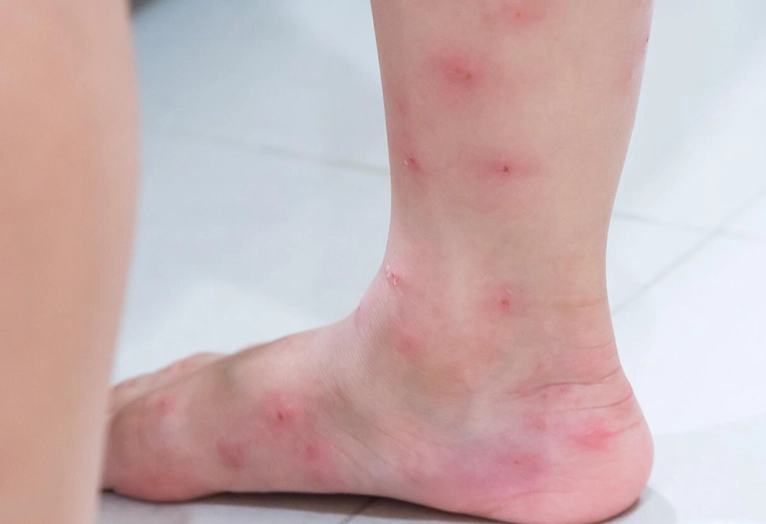 harvester ant sting symptoms