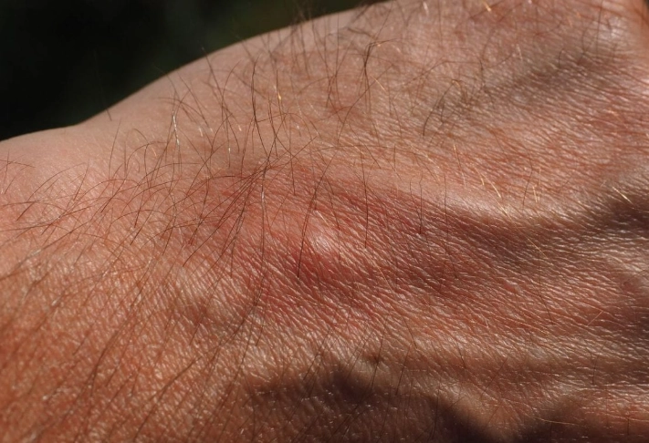 harvester ant sting symptoms