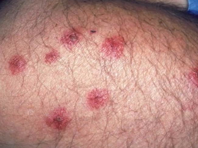 bed bug pictures