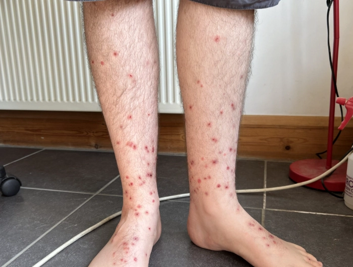 bed bug bite treatment