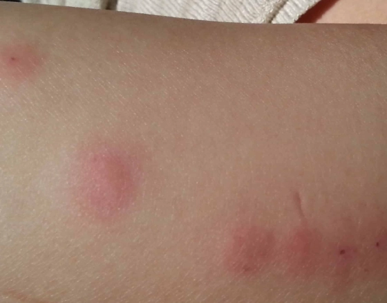 identify bed bug bites