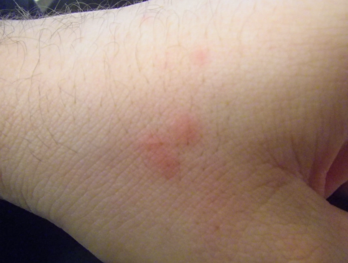 bed bug bite treatment