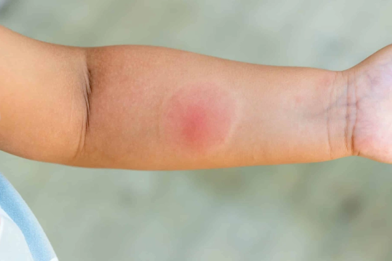 Salticidae Bite: What to Do (and Not Do) for Jumping Spider Bites