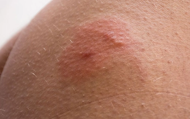 horse fly prevention