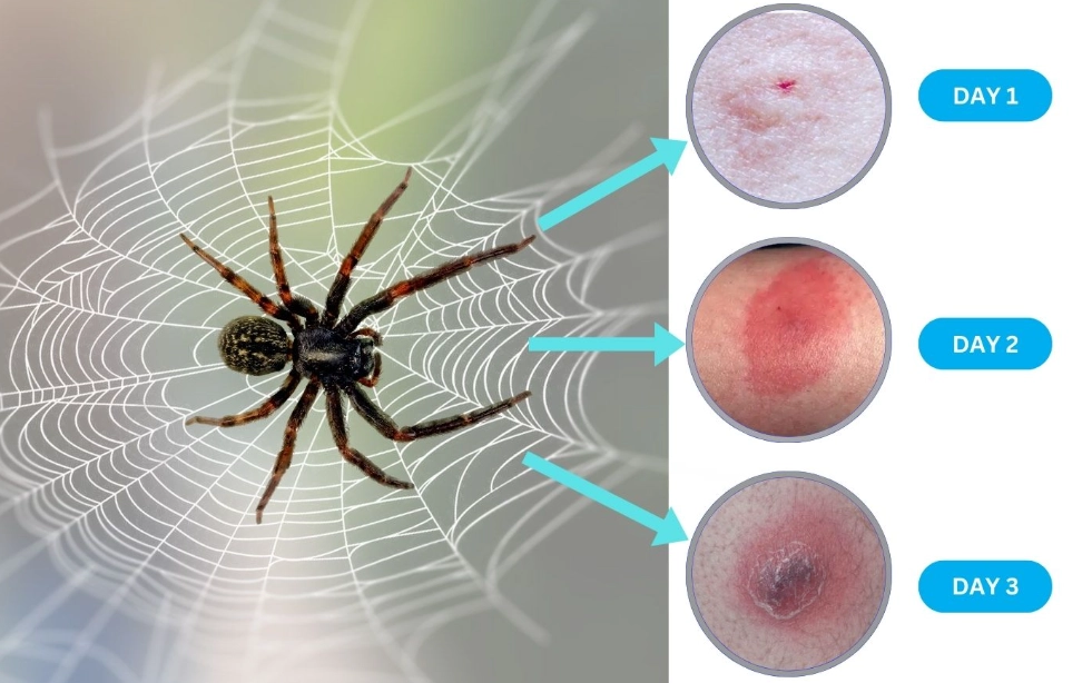 spider bite treatment