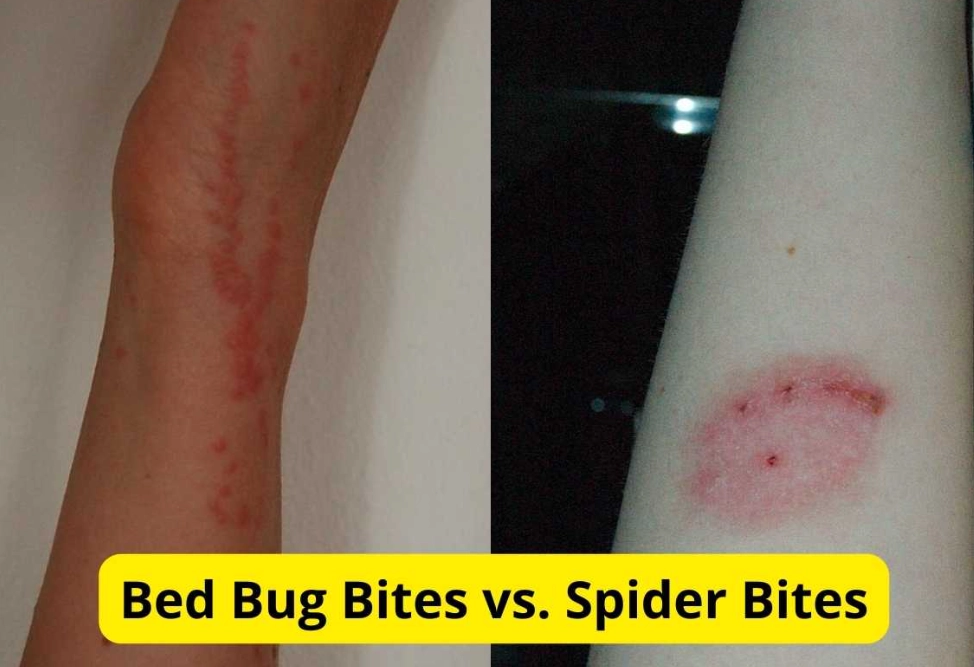 how to treat a spider bite at home