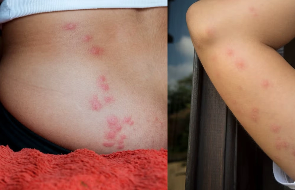 how to treat bed bug bites