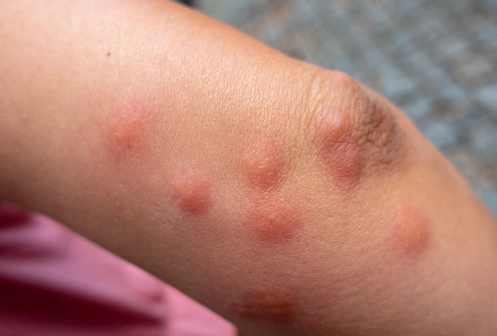 bed bug bites