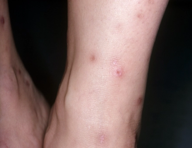 what do flea bites look like what do flea bites look like