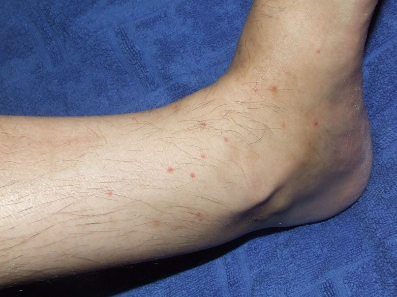 what do flea bites look like what do flea bites look like