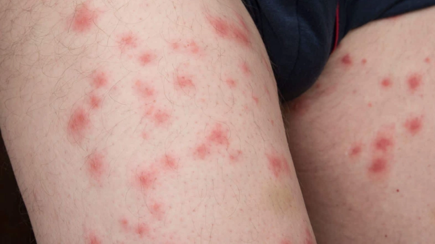 how to treat bedbug bites