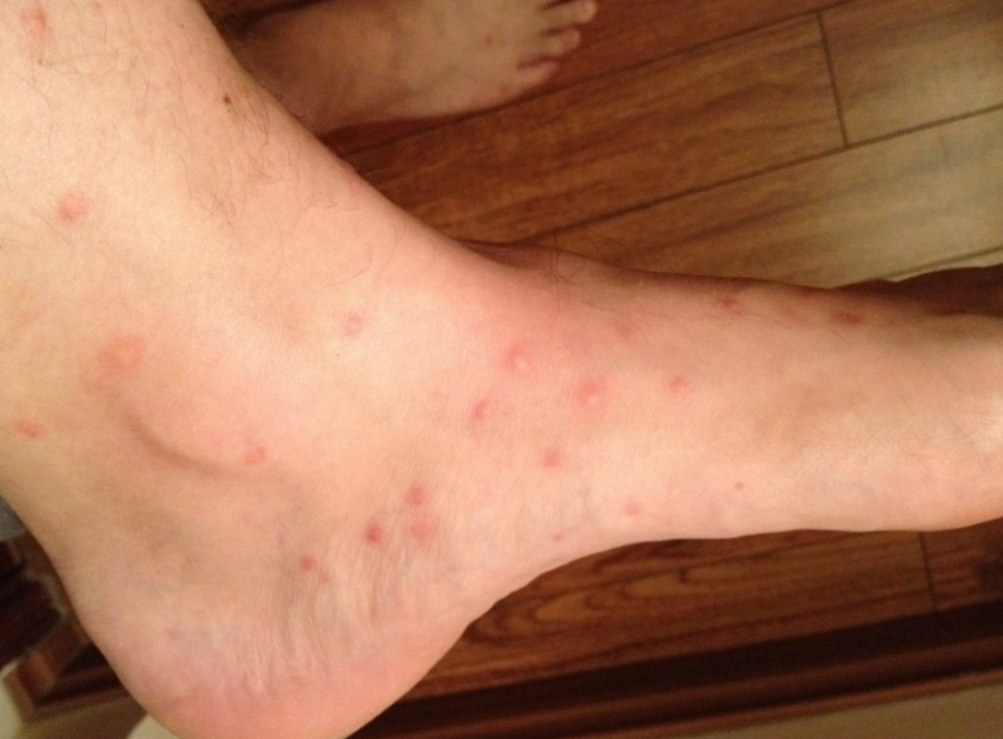 bed bug and flea bite treatment