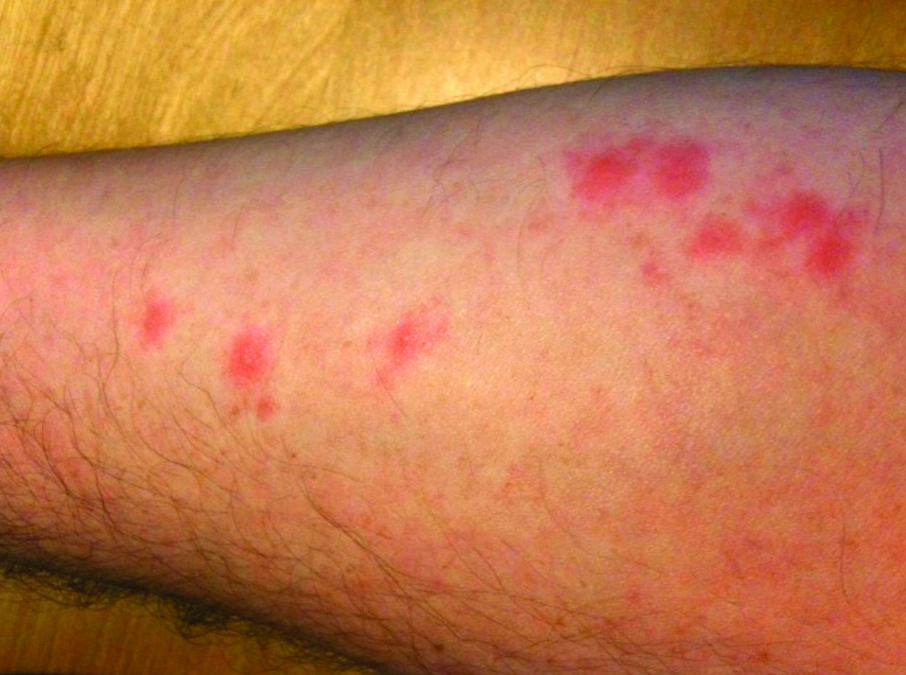 how to tell bed bug bites from flea bites