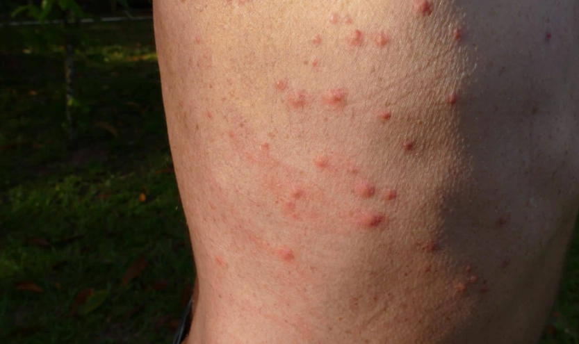 bed bug bite symptoms