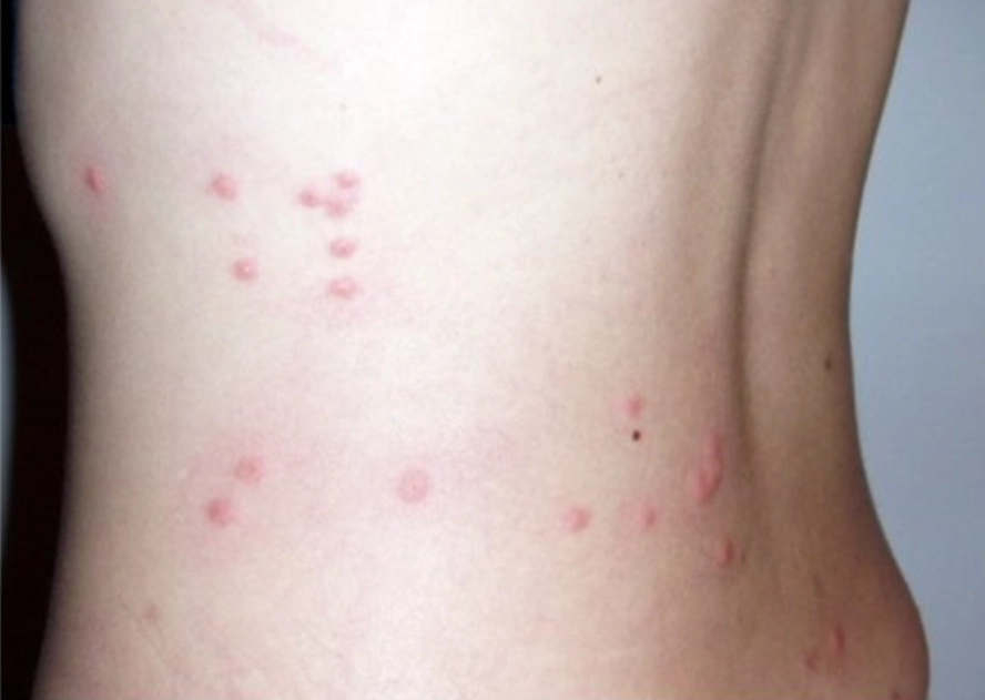 bed bug bites vs flea bites