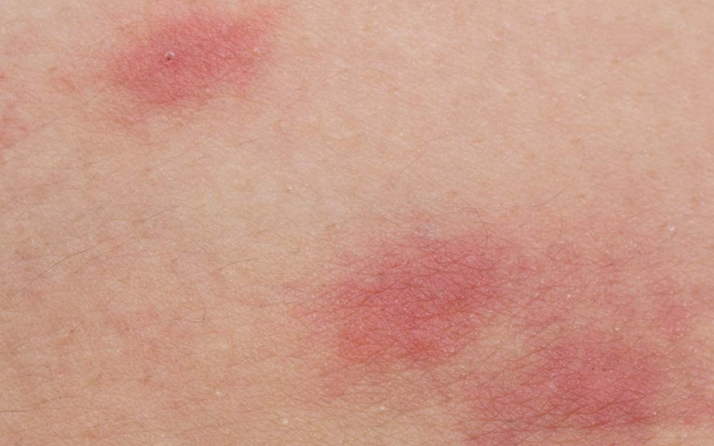 bed bug and flea bite treatment