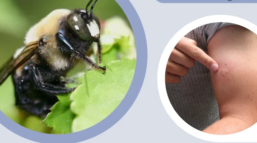carpenter bee sting