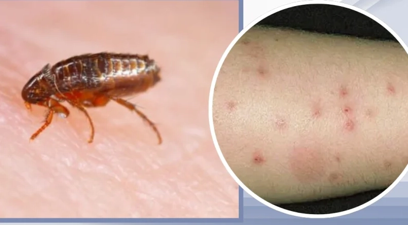 dust mite allergy