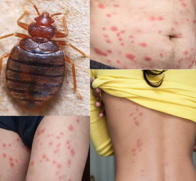 dust mite allergy