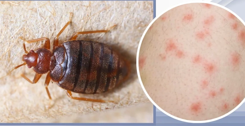 flea bites